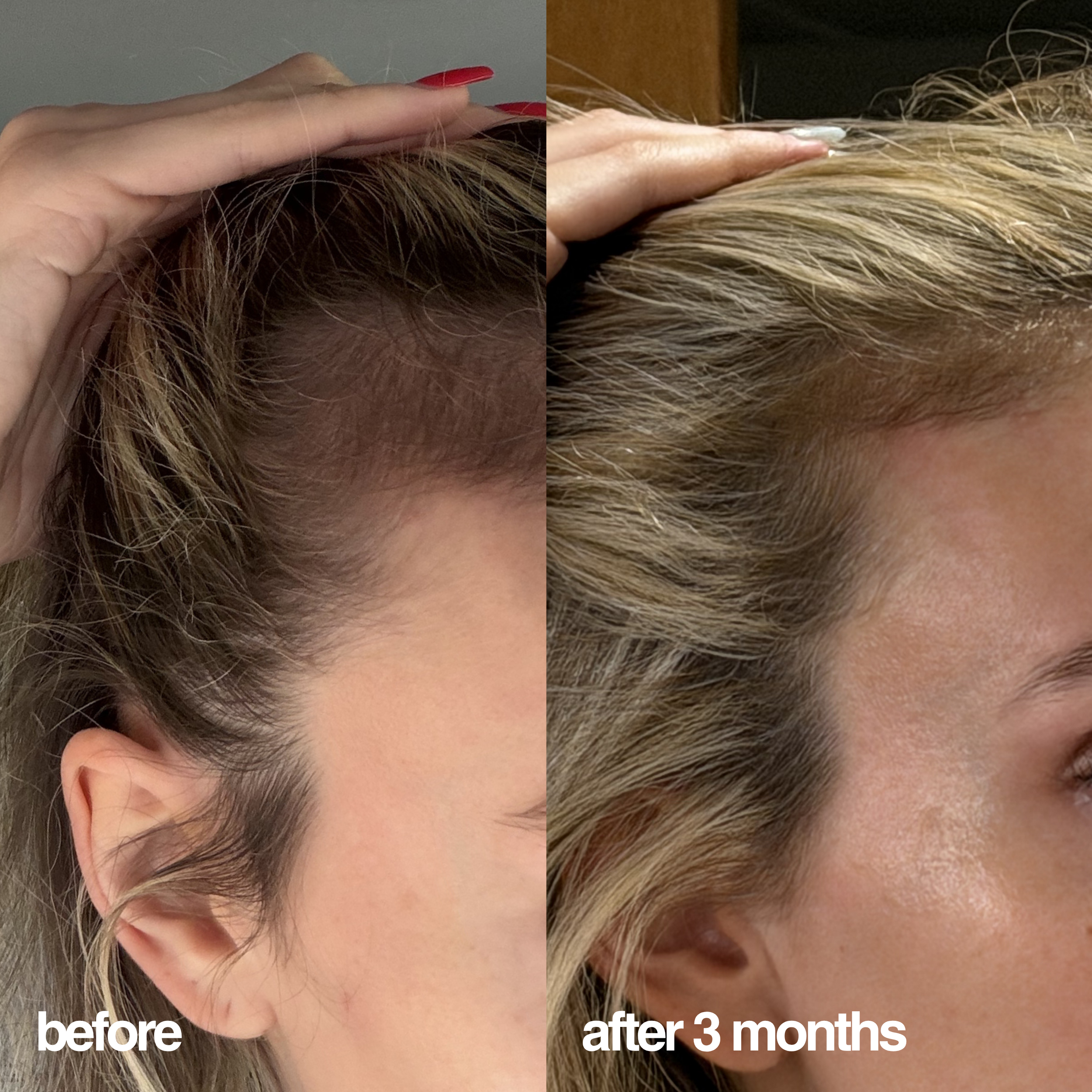 A side-by-side before and after comparison showing the results of Feel Confident® hair treatment on a woman's hairline and scalp after 3 months. 