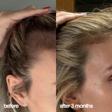 A side-by-side before and after comparison showing the results of Feel Confident® hair treatment on a woman's hairline and scalp after 3 months. 